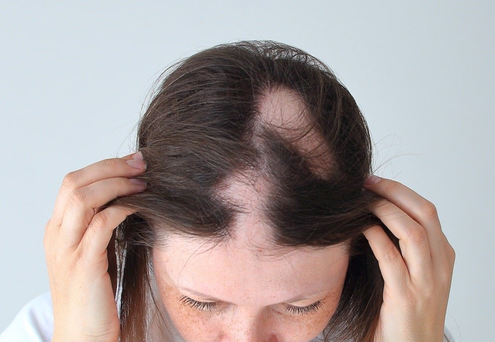  Alopecia areata Treatment