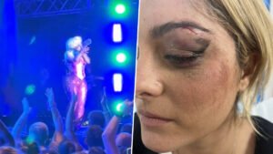 Bebe Rexha Face Injury